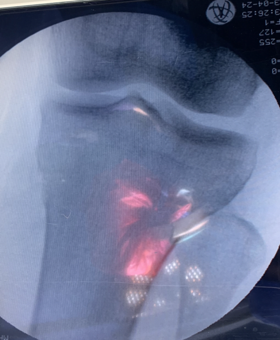 عملية الشق العظمي للركبة